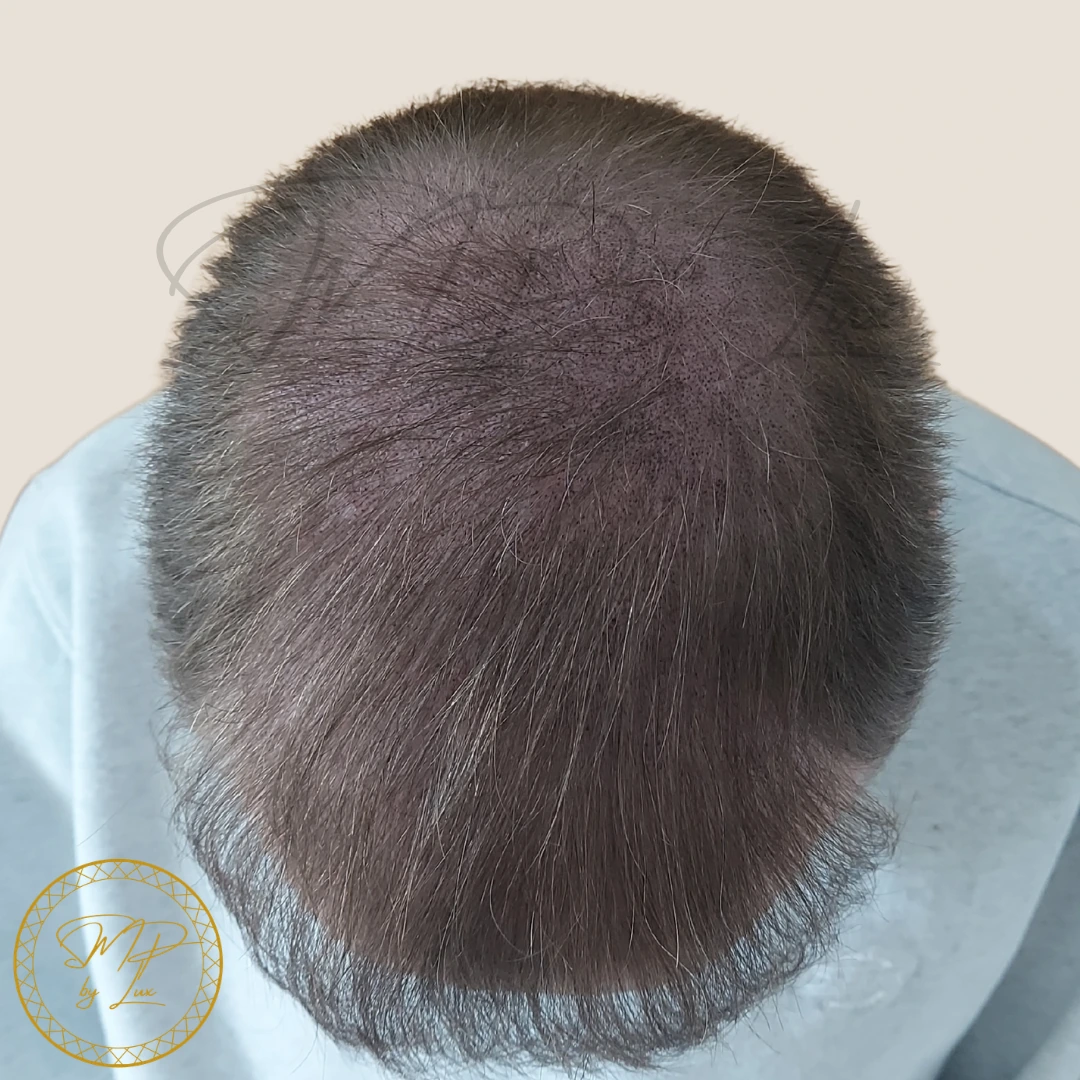 After SMP By Lux natural scalp coverage