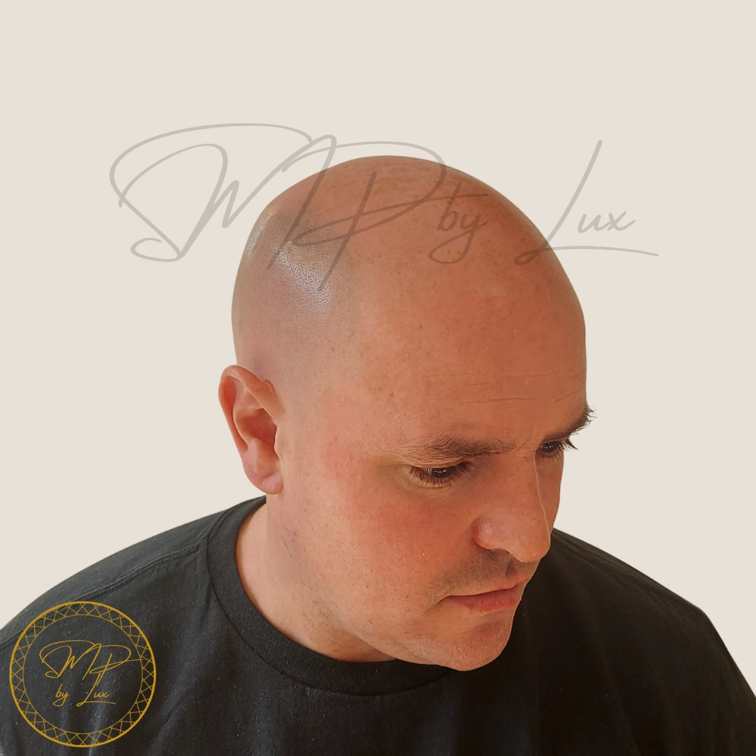 Before SMP By Lux soft hairline restoration