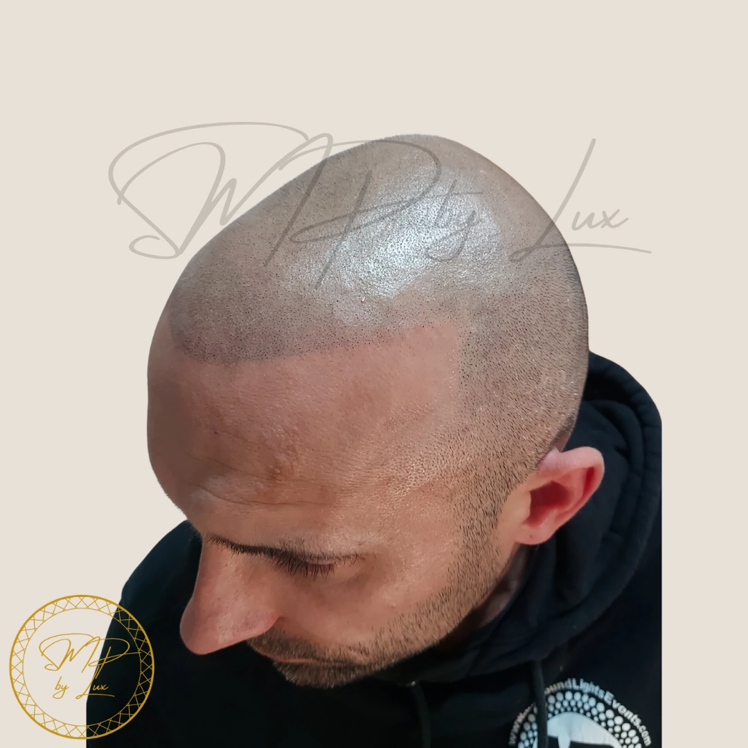 After SMP By Lux natural hairline framing