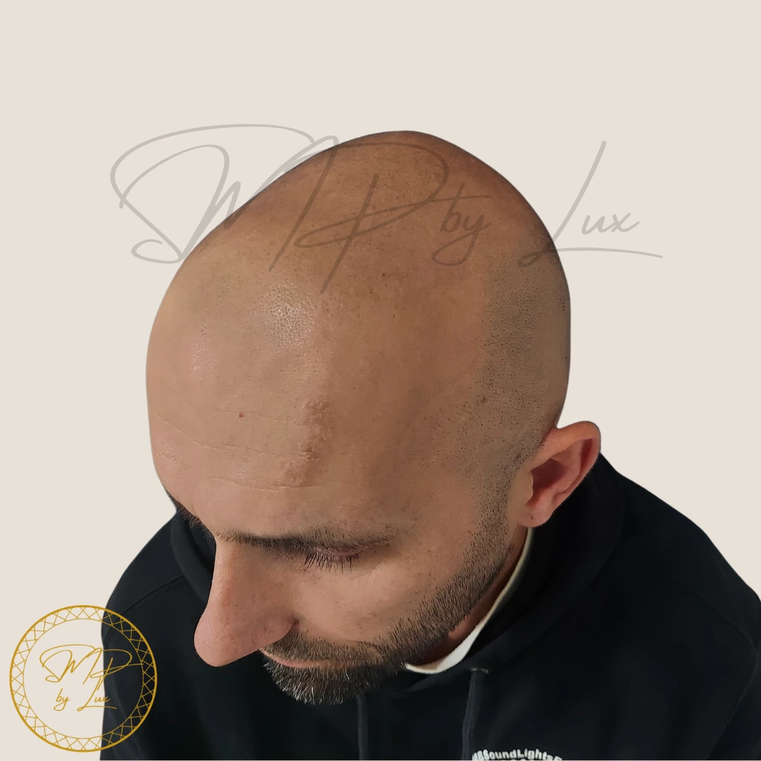 Before SMP By Lux natural hairline framing