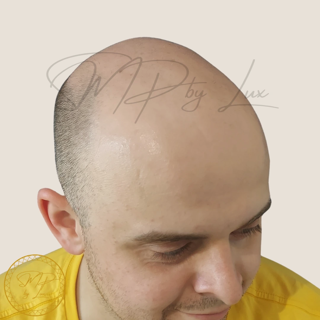 Before full-scalp SMP treatment by SMP By Lux