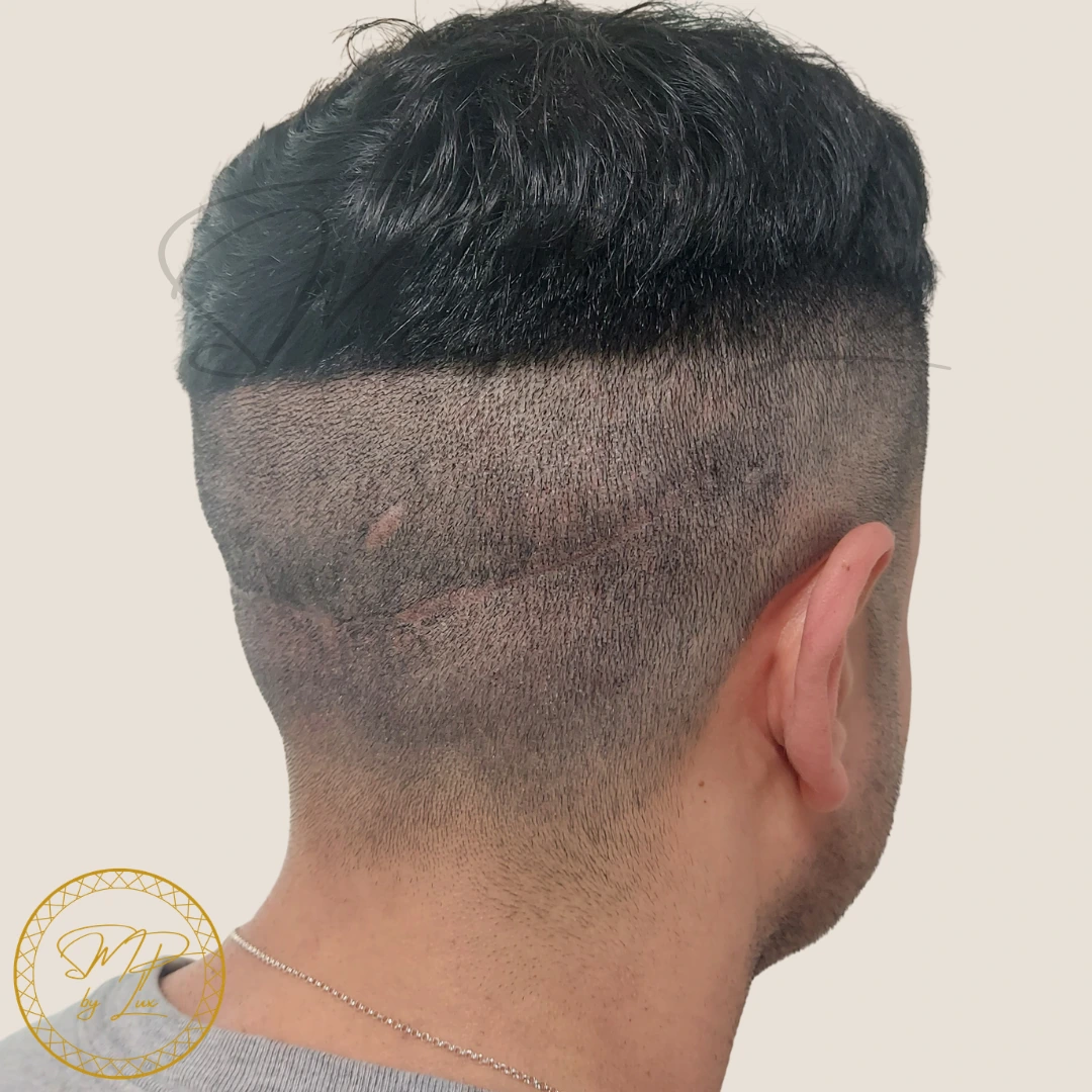 After SMP By Lux FUE and FUT donor scar camouflage