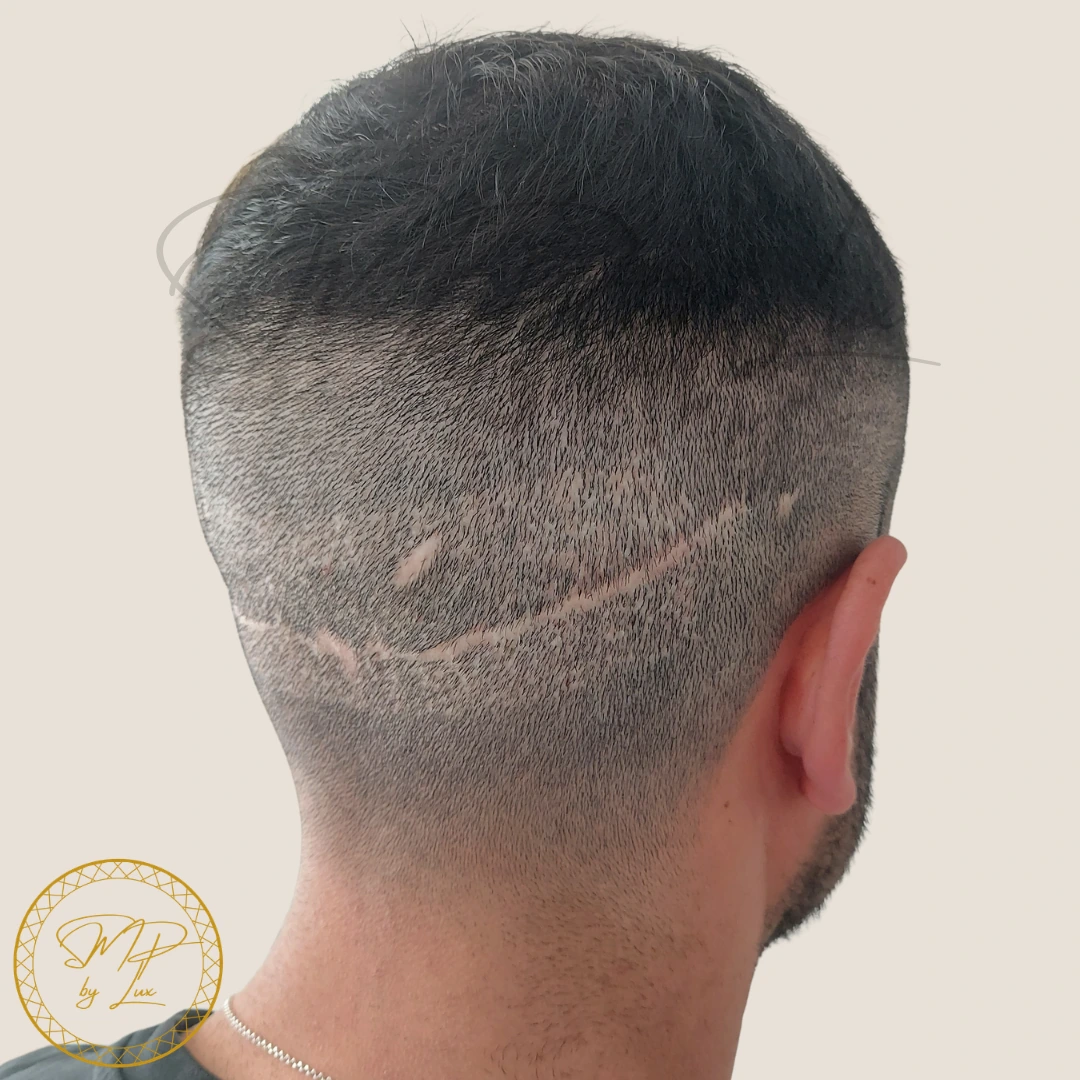 Before SMP By Lux FUE and FUT donor scar camouflage