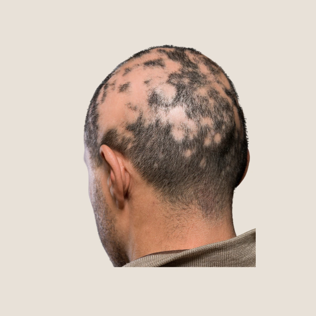 Scalp treatment consultation for alopecia and patchy hair loss
