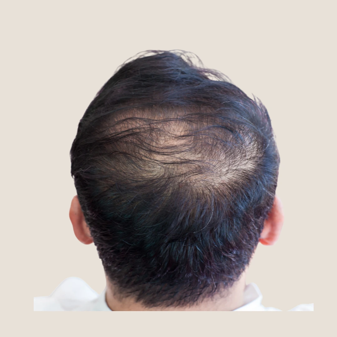 Scalp density treatment for thinning hair