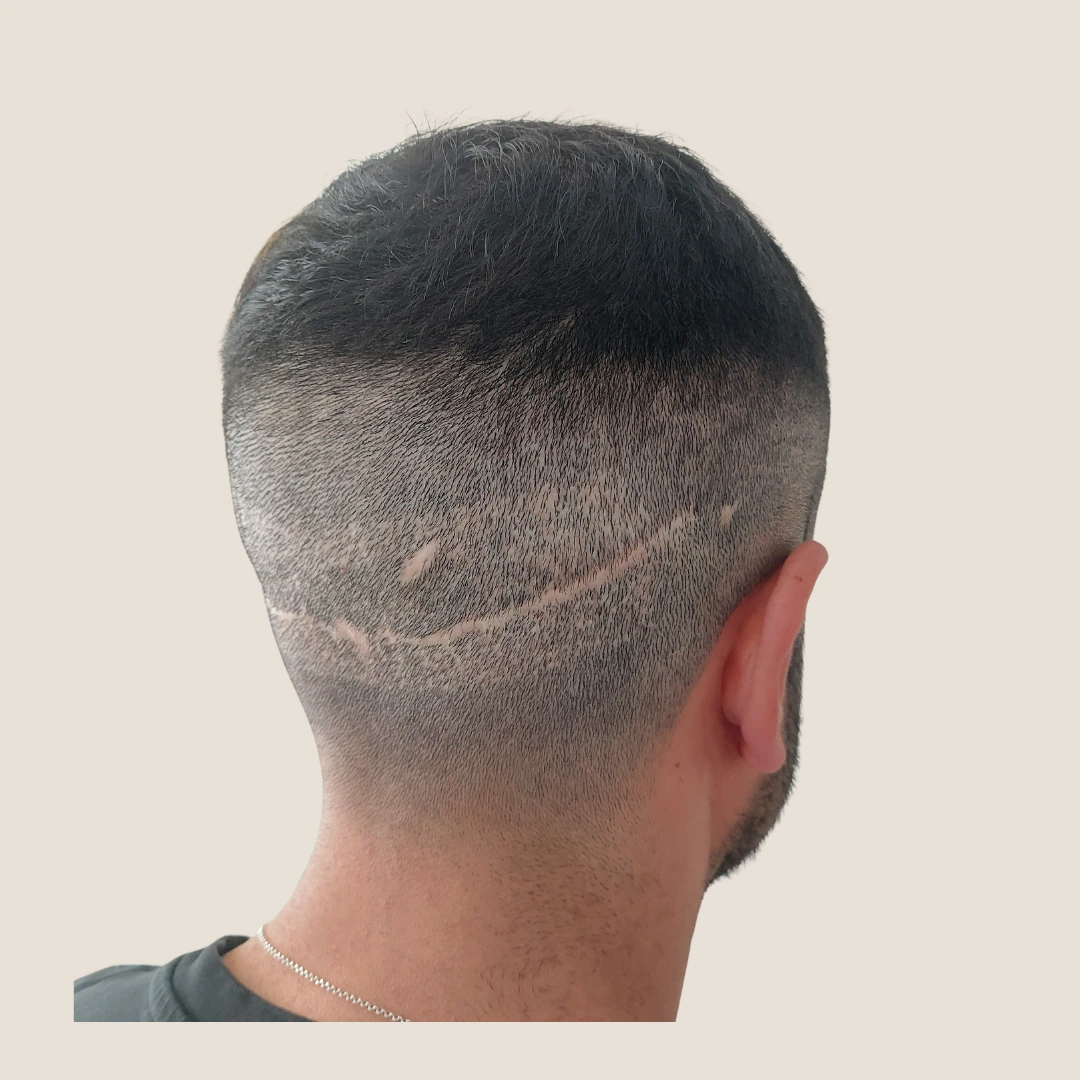 Scalp scar camouflage treatment