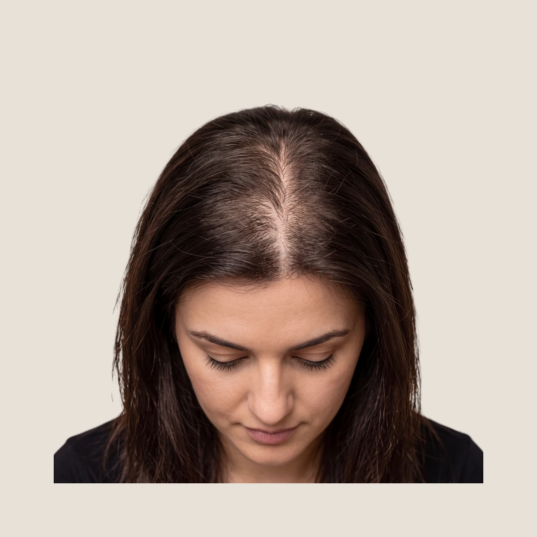 SMP density treatment for women with visible scalp through thinning hair